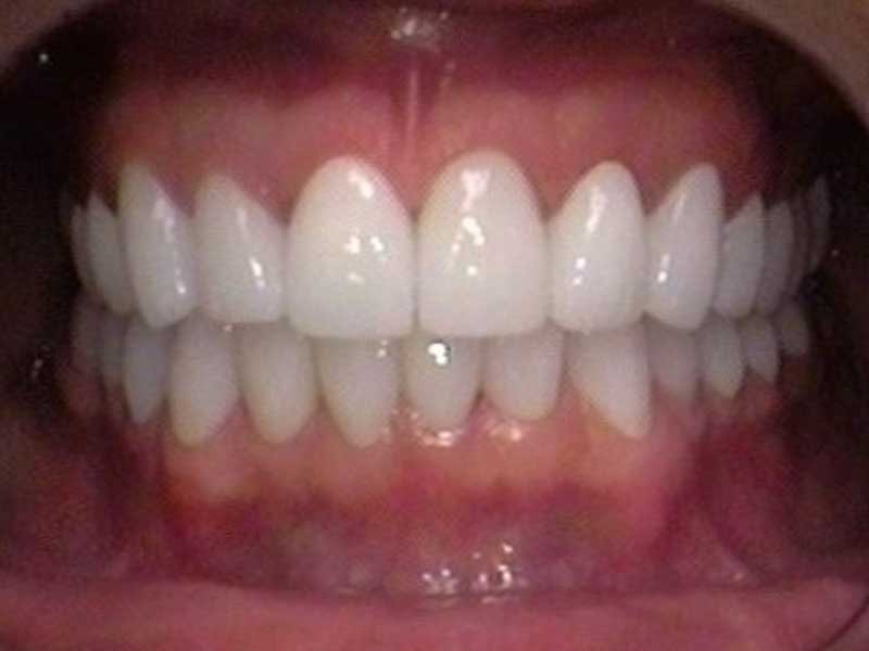 After Patient 2 • Dentist in Hialeah