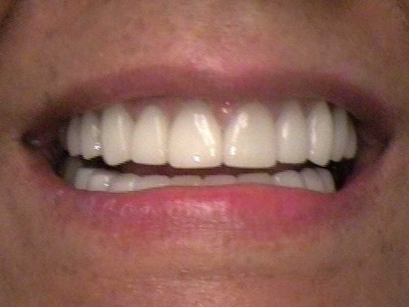 After Patient 6 • Dentist in Hialeah