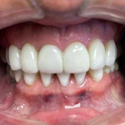 Daryl at Dental Boost After Veneers Treatment Hialeah Dentists • Dentist in Hialeah