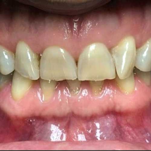 Daryl at Dental Boost Before Veneers Treatment Hialeah Dentists • Dentist in Hialeah