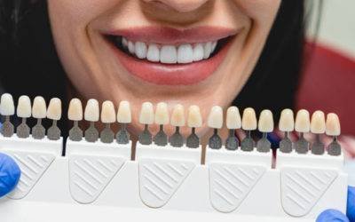 Everything you need to know about Veneers