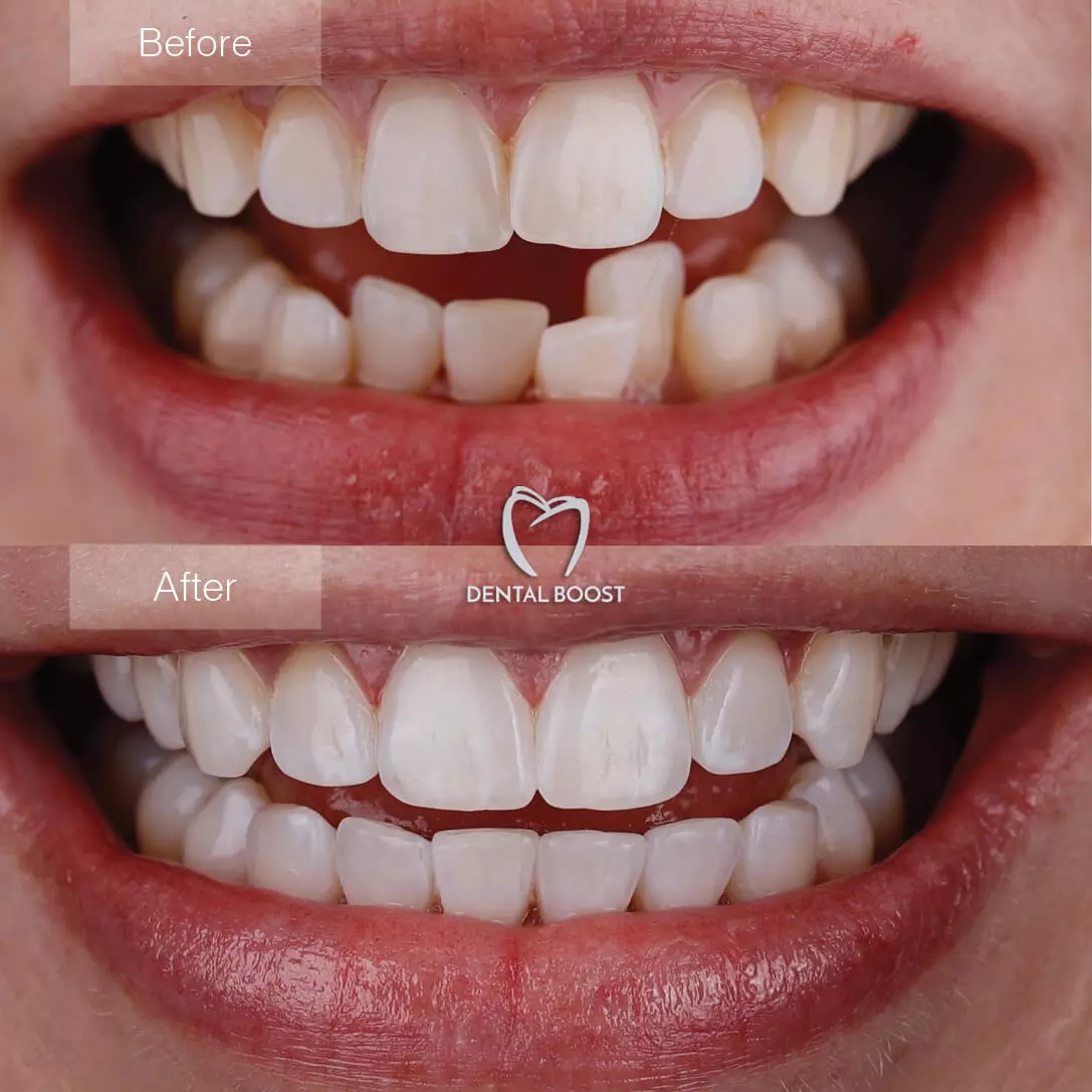 Invisalign Provider in Hialeah • Dental Boost