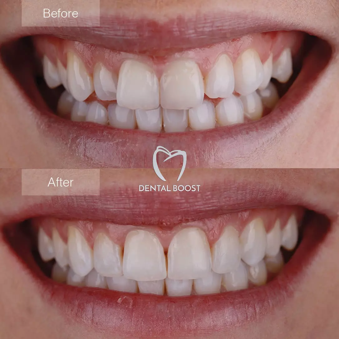 Invisalign-Treatment at Dental Boost in Hialeah 2